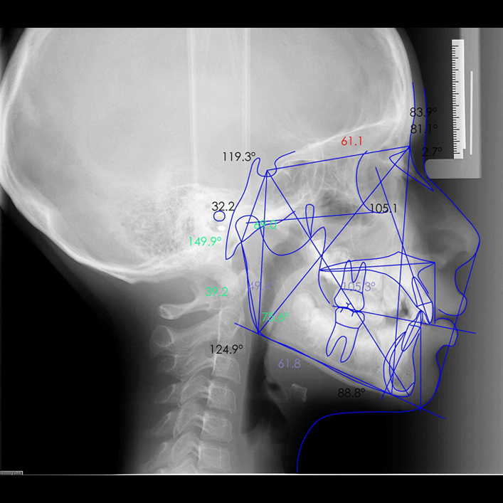 Análisis Cefalométrico Computacional